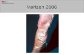 Varizen 2006. Varizen Pathologie Indikation Ziel der Operation Diagnostik Operation Nachbehandlung