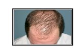Gründe für haarausfall kreisrunder haarausfall ursachen, haarausfall was hilft