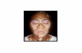 Vitiligo selbstbr¤uner, weissfleckenkrankheit vitiligo, weifleckenkrankheit ursache