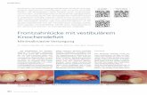 Frontzahnlücke mit vestibulärem Knochendefizit · Dr. Kathrin Spindler, Dr. Valentin Loriod, Prof. Dr. med. dent. Fouad Khoury Knöcherne und weichgewebige Defekte können durch