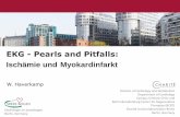 EKG - Pearls and Pitfalls: Ischämie und Myokardinfarkt · PDF file EKG: Subendokardiale Ischämie Stroobandt et al. 2016 •Bei subendokardialer Ischämie resultiert eine Verkürzung