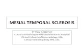 MESIAL TEMPORAL SCLEROSIS - nan.com.np · • Mesial temporal sclerosis in epilepsy: Vincent R. Spano, BMSc(H) and David J. Mikulis, MD • Magnetic Resonance Imaging of Mesial Temporal