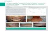 STEVENS-JOHNSON SYNDROME /TOXIC EPIDERMAL …€¦ · We described a case of TEN/SJS which ended lethal – after the treatment of peritonitis of a PD patient. In our opinion the