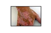 Was ist vitiligo, heilung vitiligo, mittel gegen vitiligo, vitiligo neuigkeiten, weie flecken